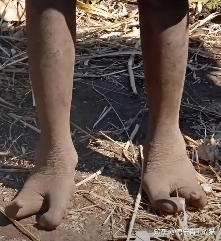 Bí ẩn về bộ tộc 'đà điểu': Không thể đi giày vì thiếu ngón chân! - Ảnh 2.