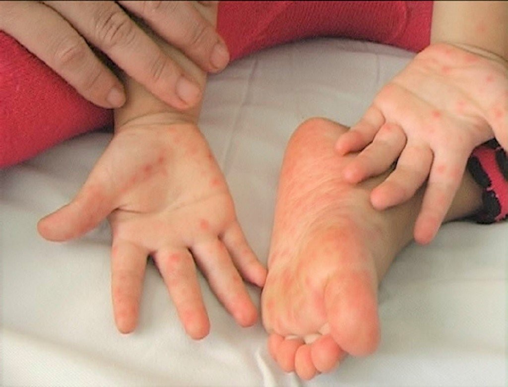 Trẻ bị tay chân miệng nên kiêng gì và ăn gì để nhanh cải thiện? - Ảnh 1. Trẻ bị tay chân miệng nên kiêng gì và ăn gì để nhanh cải thiện? - Ảnh 1.