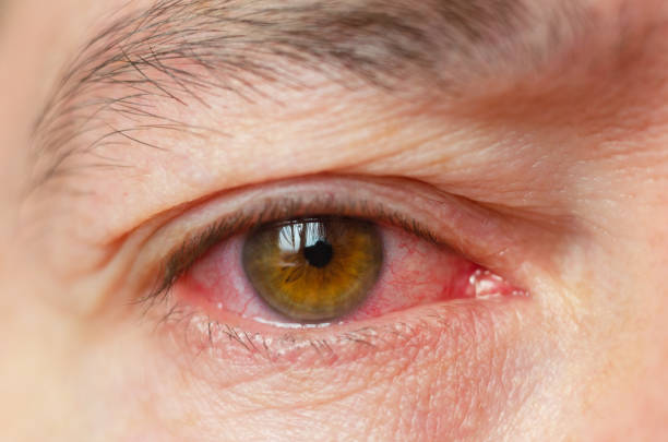 Tự ý mua thuốc chữa đau mắt đỏ, người bệnh bị loét giác mạc - Ảnh 3.
