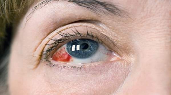 Đột quỵ mắt là gì? Dấu hiệu, nguyên nhân và cách phòng ngừa - Ảnh 1.