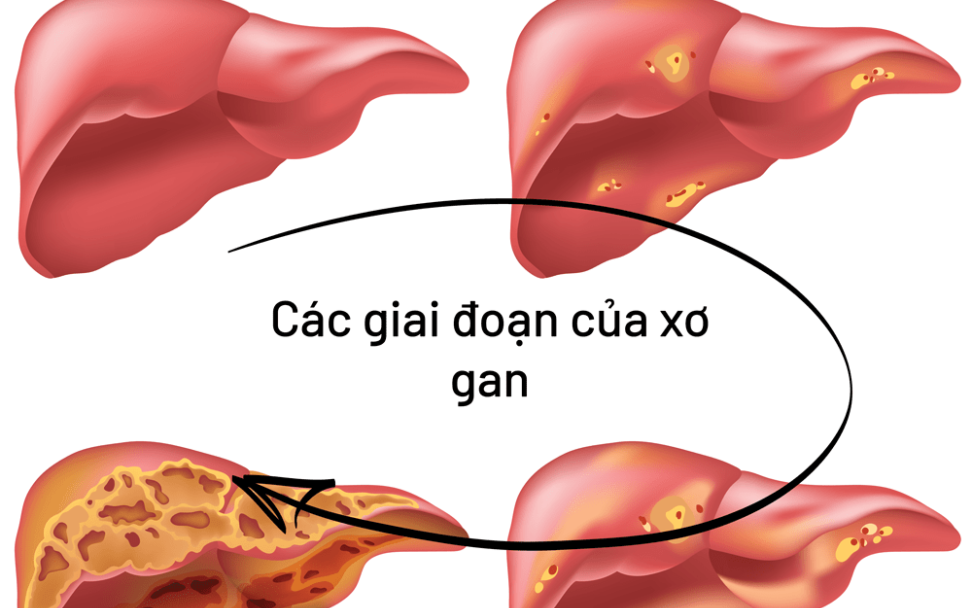 Cơ thể có 6 dấu hiệu này chứng tỏ gan của bạn đang nhiễm bệnh, cần khám gan càng sớm càng tốt!