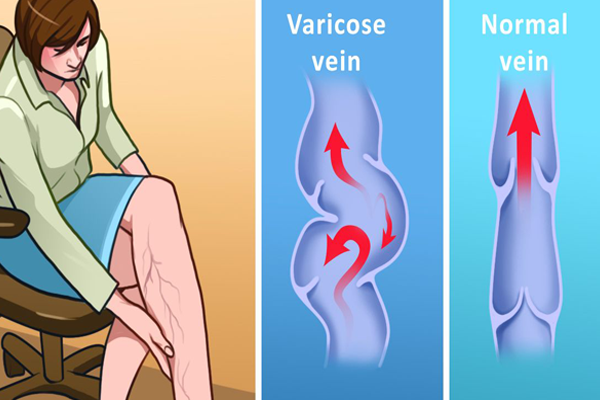 Sản phẩm đến từ Pháp hỗ trợ phòng ngừa và giảm nguy cơ suy giãn tĩnh mạch - Ảnh 1.