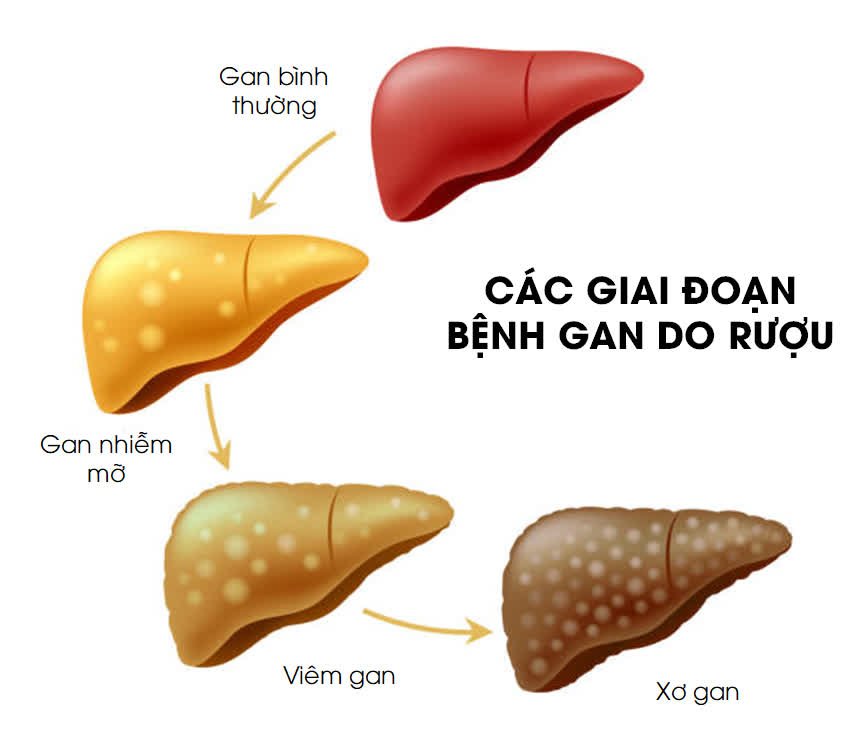 Lạm dụng rượu bia, có nên dùng thuốc bổ gan? - Ảnh 4.