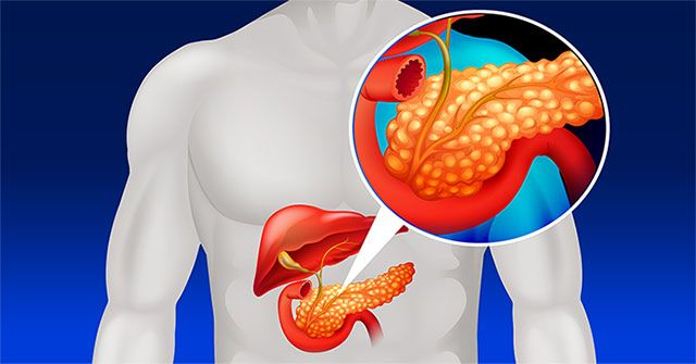 5 loại thực phẩm cần tránh tiêu thụ hằng ngày để bảo vệ tuyến tụy - Ảnh 2. 5 loại thực phẩm cần tránh tiêu thụ hằng ngày để bảo vệ tuyến tụy - Ảnh 2.