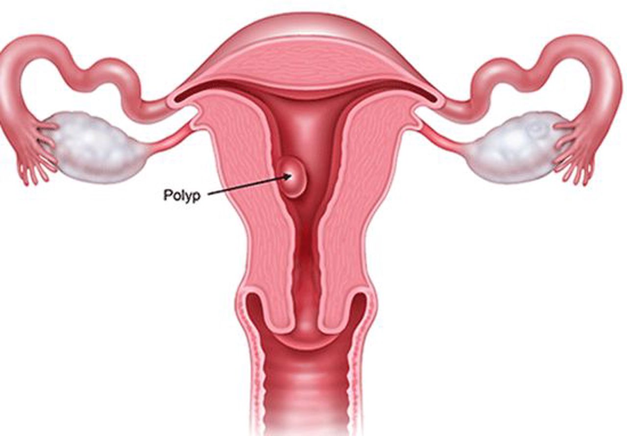 Polyp buồng tử cung gây ảnh hưởng khả năng sinh sản  thế nào?- Ảnh 1.