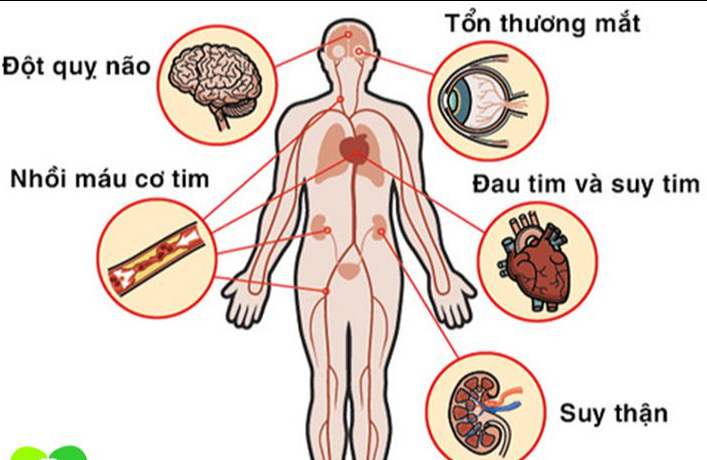 Người đàn ông đột ngột qua đời vì nhồi máu não do chủ quan với căn bệnh phổ biến này suốt 5 năm - Ảnh 3.