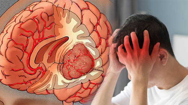 Thanh niên 21 tuổi đau đầu, ngủ li bì, đến bệnh viện mới biết u màng não, chuyên gia chỉ rõ nếu có dấu hiệu này cần khám ngay! - Ảnh 4.