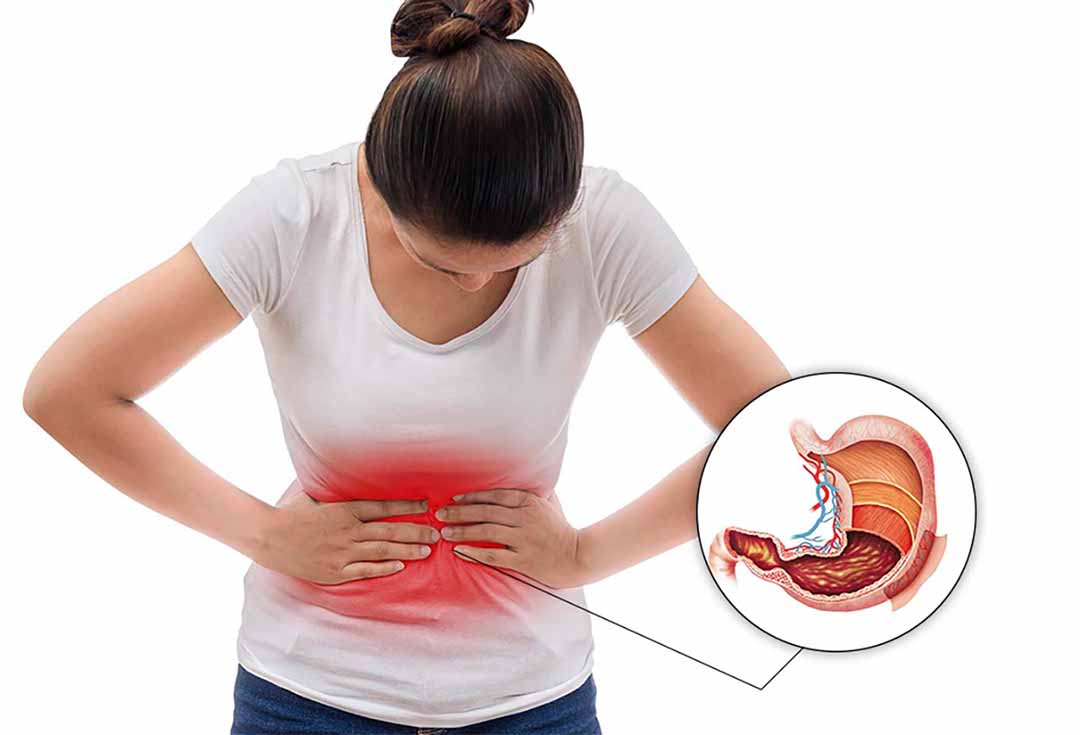 Polyp dạ dày có nguy cơ ung thư không?