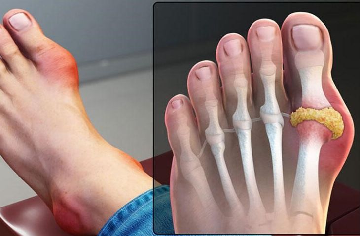 Điều trị bệnh gout cần lưu ý 3 điều sau- Ảnh 2.