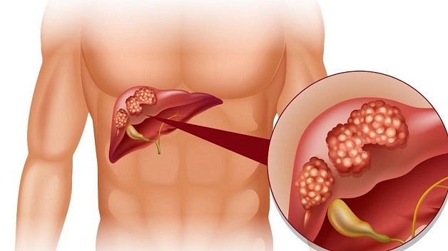 Viêm gan C là căn bệnh truyền nhiễm nguy hiểm có tỉ lệ tử vong cao. Ảnh minh họa