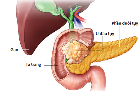 Người đàn ông 30 tuổi bất ngờ phát hiện ung thư tuyến tuỵ thừa nhận một sai lầm nhiều người Việt mắc phải- Ảnh 2.