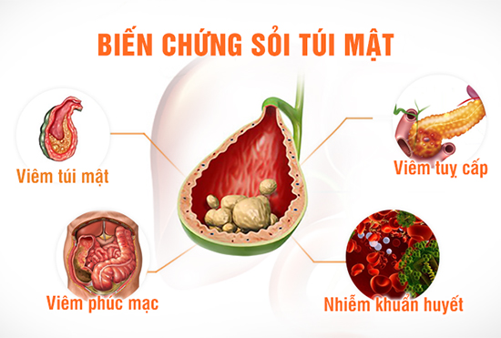 Người phụ nữ 54 tuổi ở Phú Thọ được lấy ra hàng trăm viên sỏi mật sau cơn đau hạ sườn phải