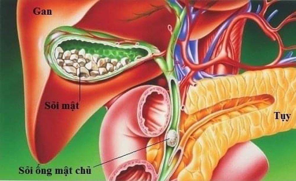 Người phụ nữ 54 tuổi ở Phú Thọ được lấy ra hàng trăm viên sỏi mật sau cơn đau hạ sườn phải- Ảnh 3.