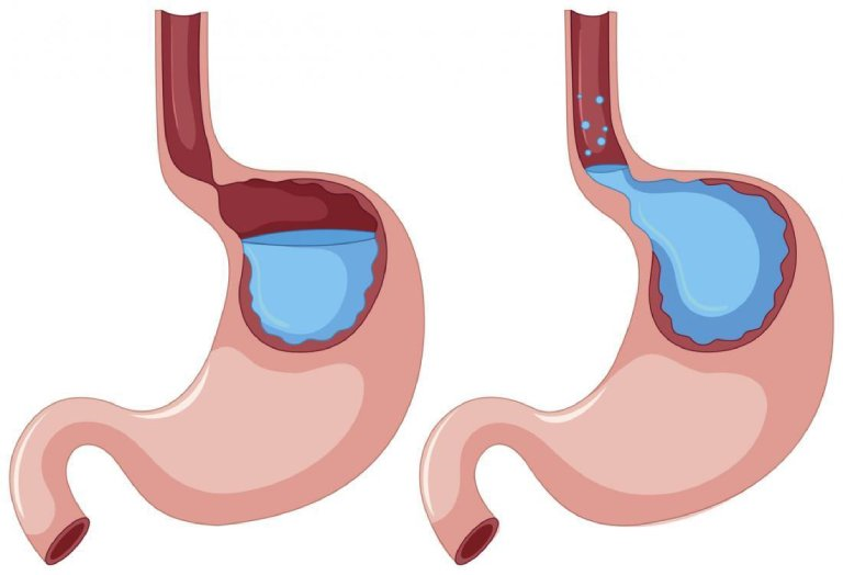 Chia nhỏ các bữa ăn trong ngày là phương pháp hiệu quả giúp giảm áp lực lên dạ dày - thực quản, tránh tình trạng trào ngược.