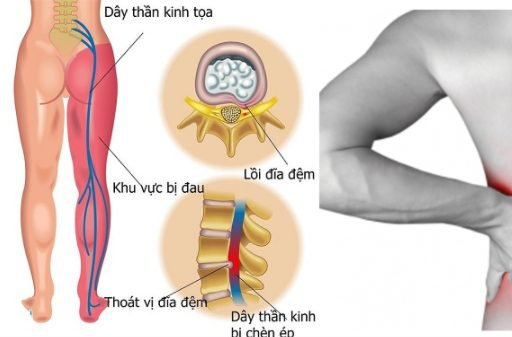 Bé 13 tuổi ở Sơn La nhập viện gấp sau khi dọn thóc giúp cha mẹ, bác sĩ chỉ rõ nguyên nhân người Việt mắc phải - Ảnh 4.