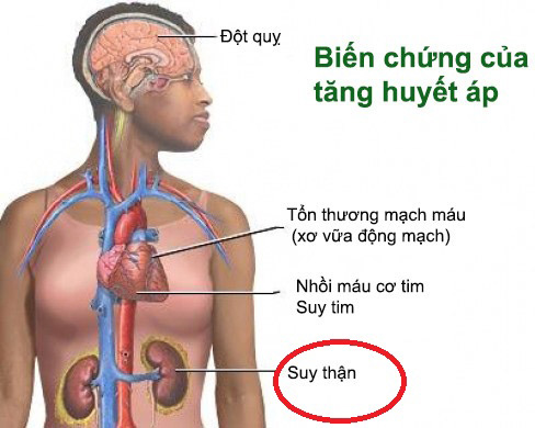 bien-chung-cua-tang-huyet-ap-gay-suy-than-17316854751811236473125.jpg