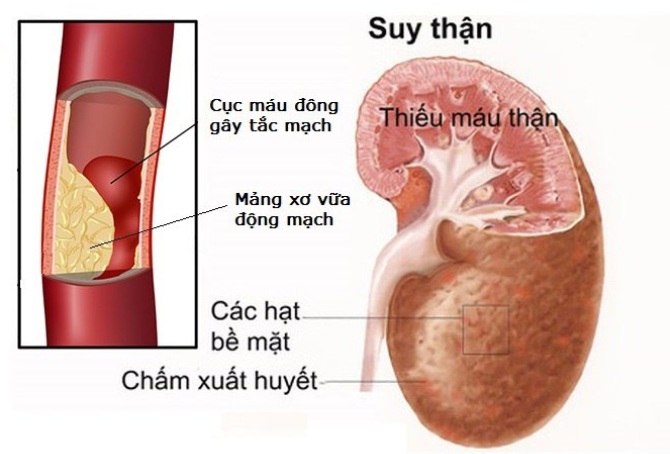 Thanh niên 21 tuổi suýt mất mạng vì suy thận và cao huyết áp, thừa nhận những sai lầm nhiều người Việt mắc phải  - Ảnh 4.