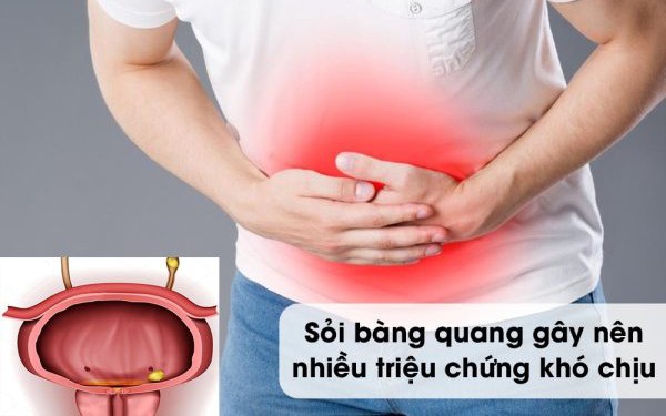 Người đàn ông 49 tuổi ở Phú Thọ nhập viện gấp, tăng nguy cơ suy thận do sỏi bàng quang gây tắc nghẽn đường tiểu