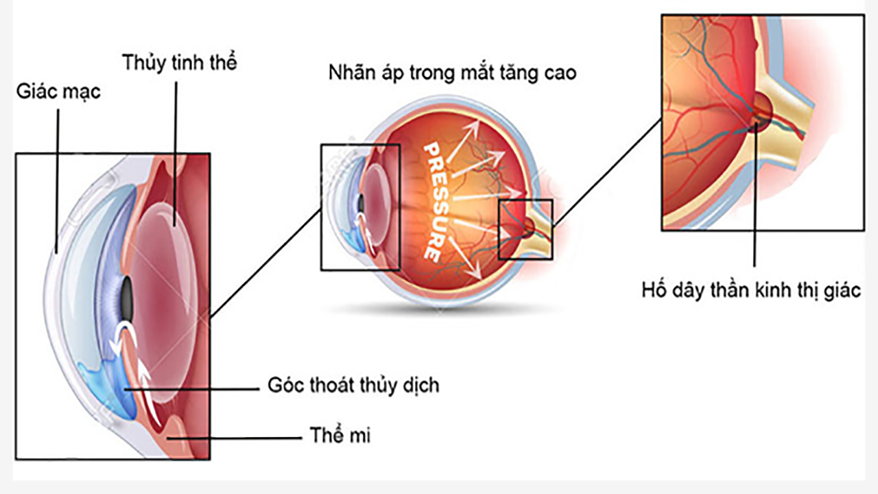 tang-nhan-ap-la-gi-1-1733319829495169368683-1733876452140-17338764523881429993605.jpg