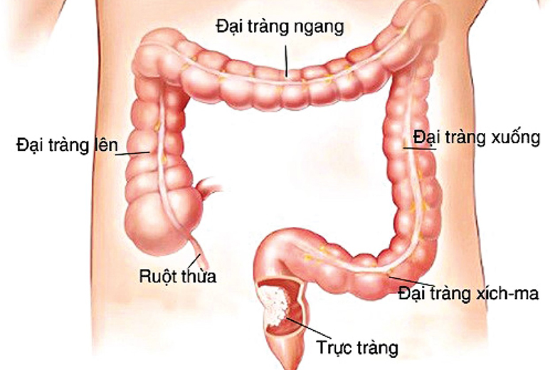 ung-thu-dai-truc-trang-16924302932041968261354-1734512260882-17345122611431773349415.jpg