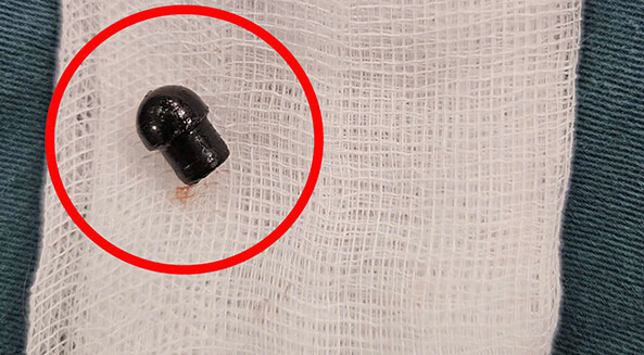 Bé trai 7 tuổi tử vong do hóc đầu bút: Cần làm gì để cứu con trong những tình huống nguy cấp?- Ảnh 2.