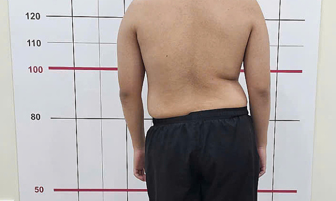 Ein 19-jähriger Mann stellte plötzlich fest, dass seine Wirbelsäule um 50 Grad gekrümmt war. Er gab zu, dass ihm dies beim Training im Fitnessstudio oft passierte – Foto 2. Thanh niên 19 tuổi bất ngờ phát hiện cột sống cong 50 độ, thừa nhận thường xuyên làm việc này trong lúc tập gym - Ảnh 2.