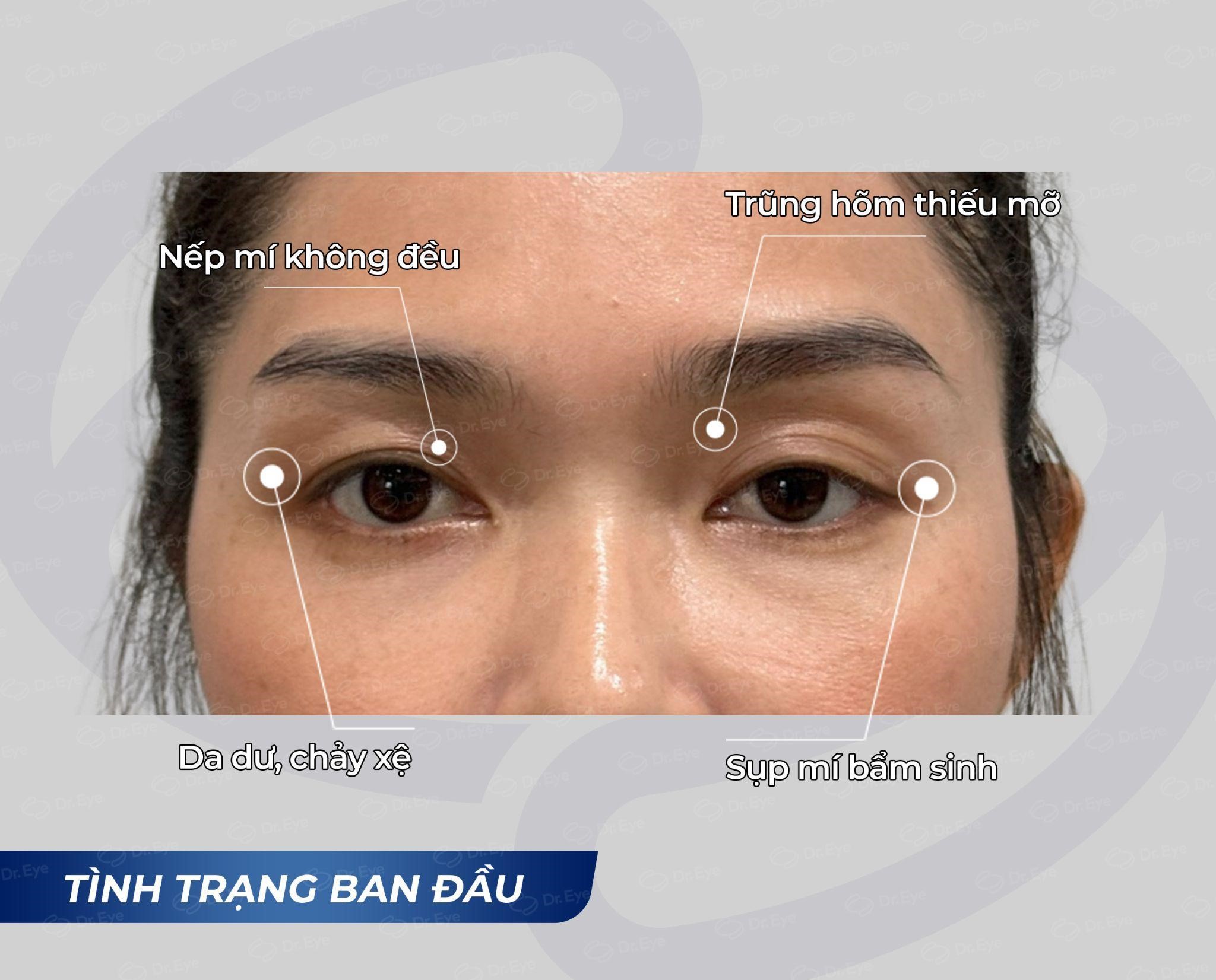 Chi phí chống lão hóa mí mắt trên: Thế nào là hợp lý?- Ảnh 1.