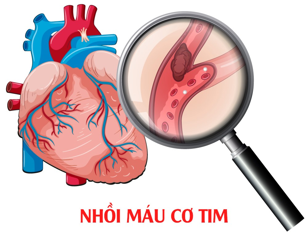 Bệnh thiếu máu cơ tim có nguy hiểm không? Tất cả những điều bạn cần biết- Ảnh 3.