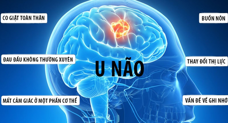 Người phụ nữ ở Phú Thọ bất ngờ phát hiện u não từ dấu hiệu rất nhiều người Việt mắc phải- Ảnh 3.