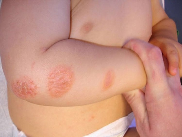 Da bé sơ sinh vốn non nớt nên những vết mẩn đỏ, những hạt mụn li ti trên da hầu như bé nào cũng gặp. Ảnh minh họa