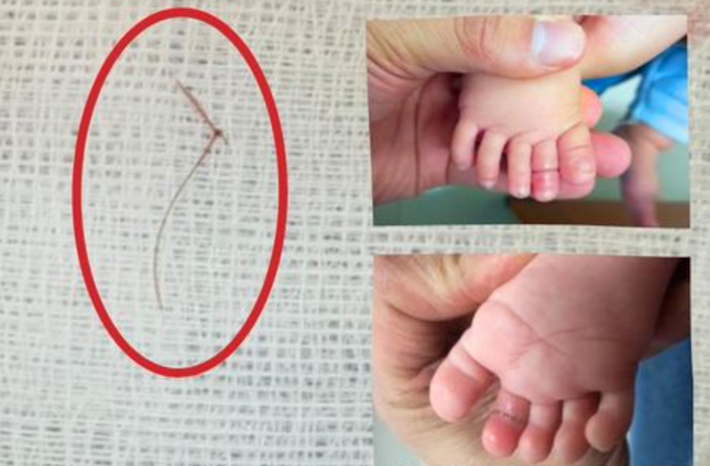 Sợi tóc thắt vào chân, bé gái 4 tháng tuổi suýt mất ngón - Ảnh 1.