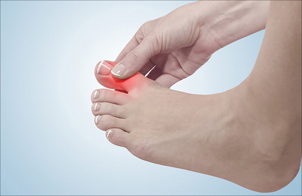 Để điều trị được, điều quan trọng là phải xác định các triệu chứng của bệnh Gout và viêm khớp dạng thấp.