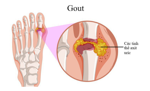 Gout và viêm khớp dạng thấp vốn là bệnh lý về khớp. Tuy nhiên các triệu chứng cũng đặc điểm sẽ khác nhau.