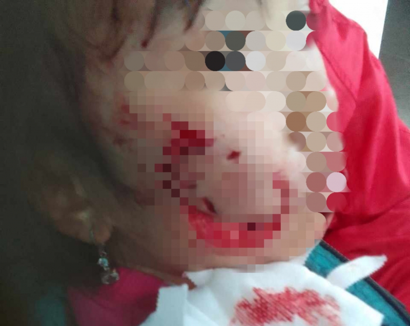 Bé gái 5 tuổi bị chó dữ cắn trọng thương vùng mặt - Ảnh 1.