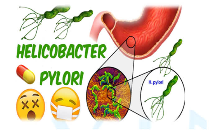 helicobacter-pylori-16335717279441556868266-1709355860441-1709355860803987263014.jpg