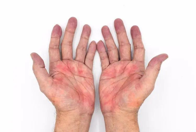Bác sĩ ung bướu tiết lộ &quot;điềm báo&quot; ung thư lộ rõ trên bàn tay: Có 3 điểm bất thường nên đi khám khẩn cấp- Ảnh 2.