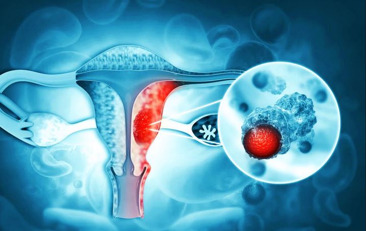 4 loại ung thư thường gặp ở phụ nữ và cách phát hiện sớm- Ảnh 1.