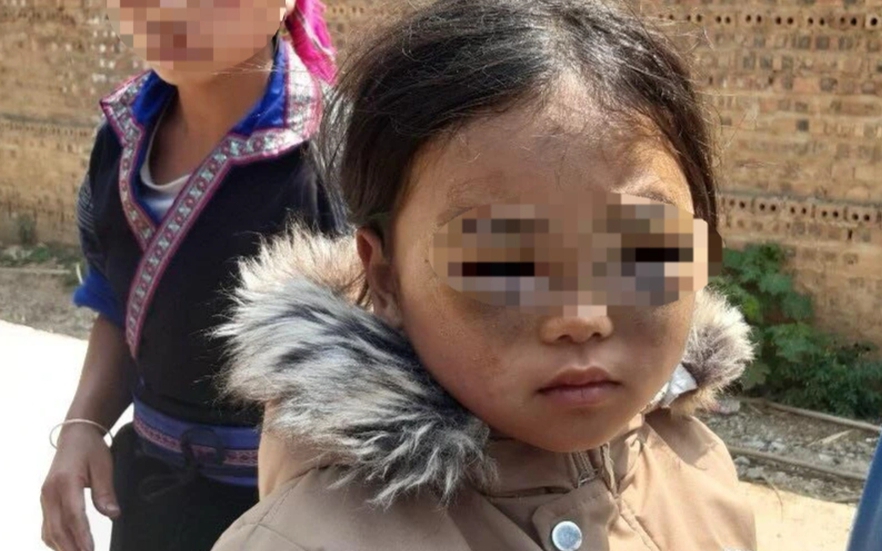 Tạm đình chỉ giáo viên nghi đánh bé gái lớp 1 thâm tím 2 mắt ở Yên Bái