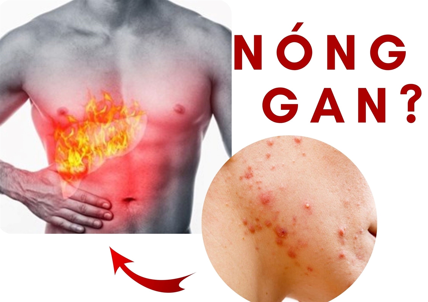 کبد داغ چقدر خطرناک است؟ برای خنک کردن کبد در روزهای گرم چه باید کرد - عکس ۲. Nóng gan nguy hiểm thế nào? Làm gì để 'giải nhiệt' cho gan trong ngày nắng nóng - Ảnh 2.