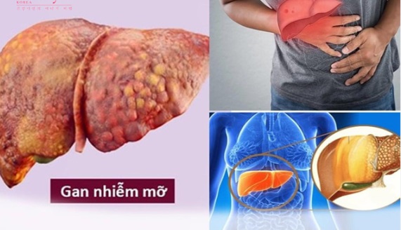 6 nhóm người có nguy cơ cao, cần đề phòng bệnh gan nhiễm mỡ - Ảnh 3.