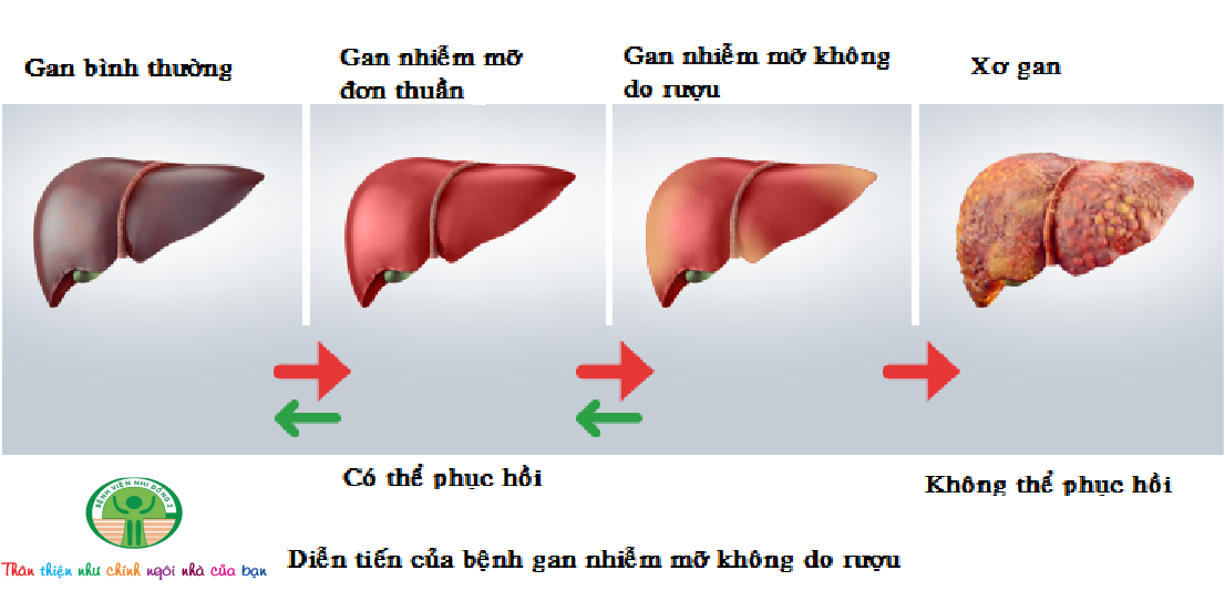 Biến chứng đáng sợ của bệnh gan nhiễm mỡ, biết sớm bạn có thể tự phòng ngừa- Ảnh 3.