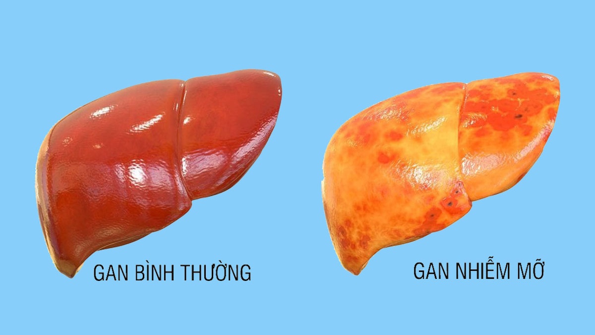 Biến chứng đáng sợ của bệnh gan nhiễm mỡ, biết sớm bạn có thể tự phòng ngừa- Ảnh 2.