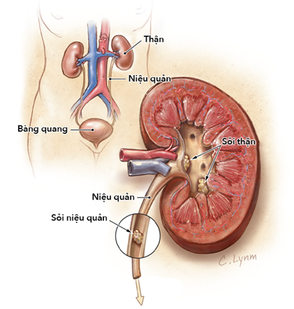 Người phụ nữ 53 tuổi ở Phú Thọ phải cắt 1 bên thận vì chủ quan với chứng bệnh này - Ảnh 3.