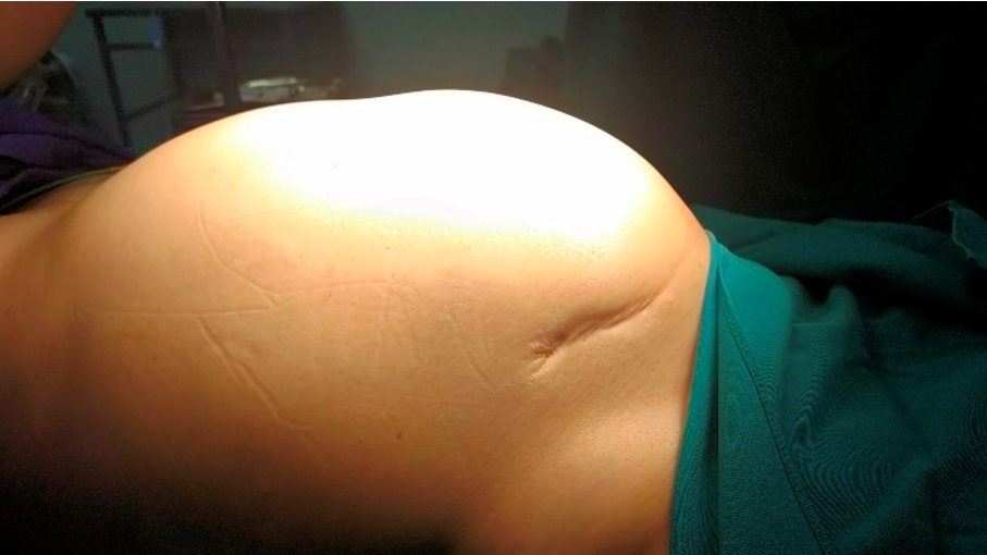 Nghĩ béo bụng, người phụ nữ bàng hoàng khi phát hiện khối u buồng trứng nặng gần 13kg- Ảnh 2.
