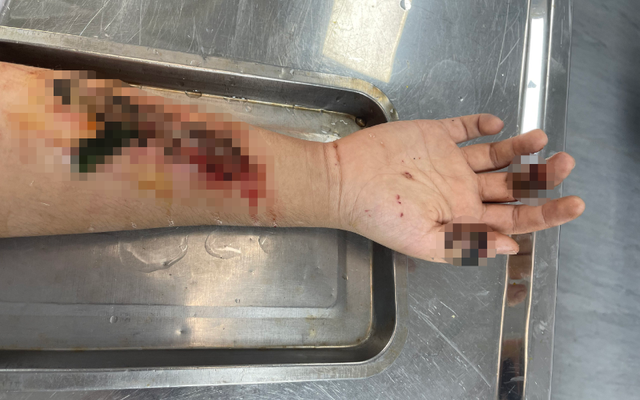 Tự đắp lá vào vết thương, nam bệnh nhân 17 tuổi suýt bị hoại tử cánh tay  - Ảnh 1.