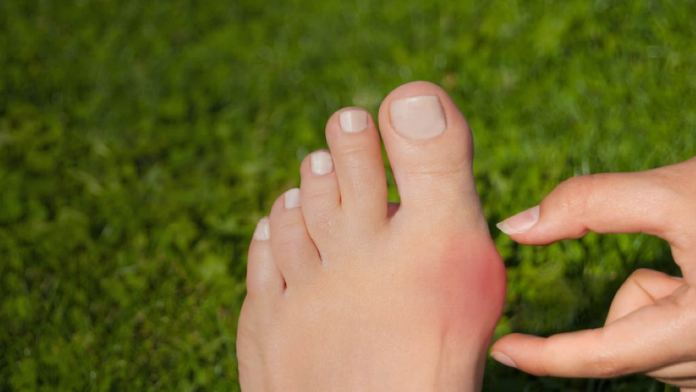 Tía tô có chữa được bệnh gout không?- Ảnh 2.