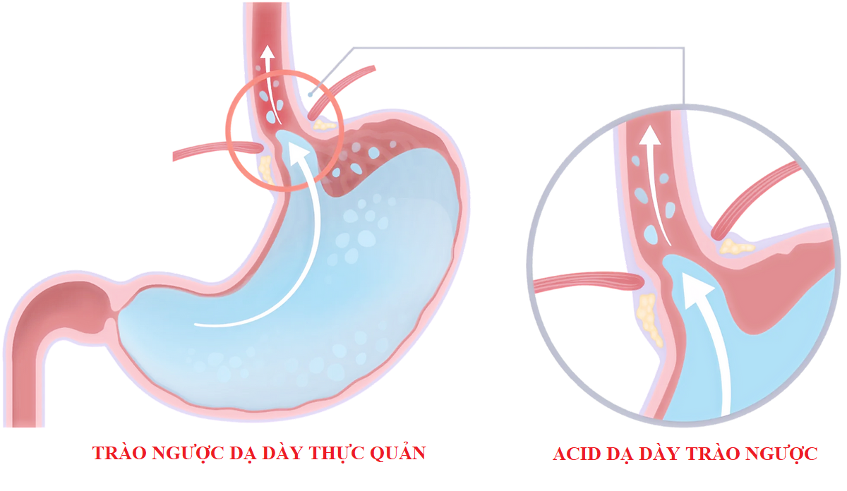 Trào ngược dạ dày thực quản: Sự khó chịu và cách cải thiện- Ảnh 2.