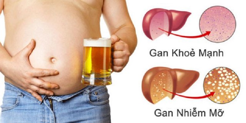 Giảm cân sai cách, cô gái 26 tuổi bất ngờ mắc bệnh gan nhiễm mỡ nặng - Ảnh 3.