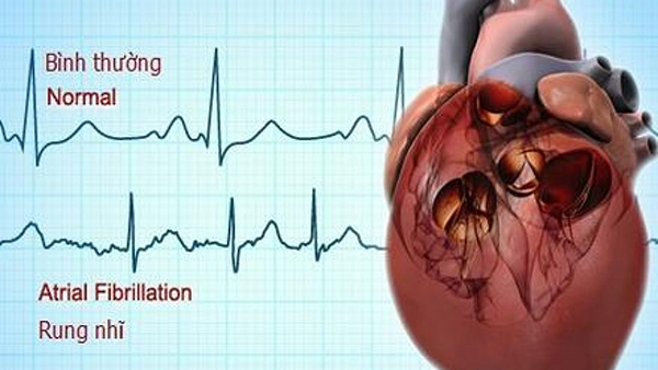 Rung nhĩ - căn bệnh dễ tăng nguy cơ đột quỵ ít người biết đến  - Ảnh 4.