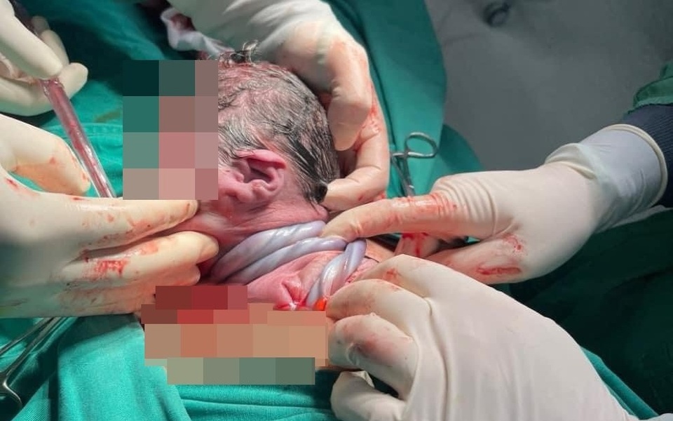 Em bé ở Hà Nội chào đời với dây rốn quấn 3 vòng cổ